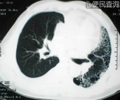 心肺同时移植首次在西班牙完成